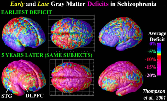 schizophrenia brain ventricles